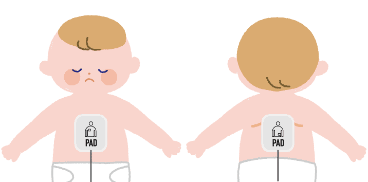 子供へのAEDパッドの貼り方