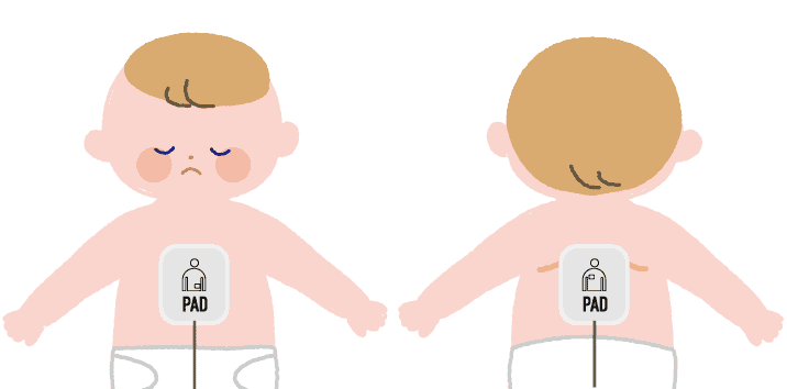 子供へのAEDパッドの貼り方